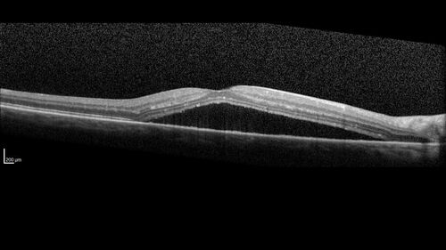 Serous Macular Detachment from Small Choroidal Melanoma
72 year old female misdiagnosed as CSR who had small choroidal melanoms.
