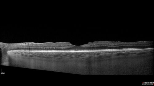 Serous Macular Detachment from Small Choroidal Melanoma
72 year old female misdiagnosed as CSR who had small choroidal melanoms.
