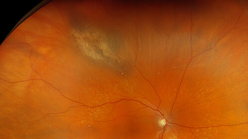 Serous Macular Detachment from Small Choroidal Melanoma
72 year old female misdiagnosed as CSR who had small choroidal melanoms.
