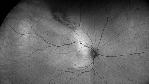 Serous Macular Detachment from Small Choroidal Melanoma
72 year old female misdiagnosed as CSR who had small choroidal melanoms.
