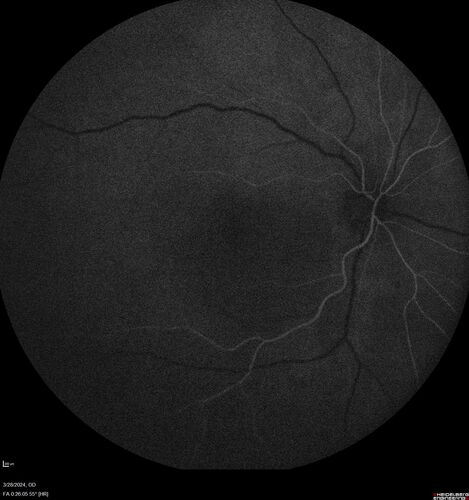Serous Macular Detachment from Small Choroidal Melanoma
72 year old female misdiagnosed as CSR who had small choroidal melanoms.
