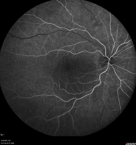 Serous Macular Detachment from Small Choroidal Melanoma
72 year old female misdiagnosed as CSR who had small choroidal melanoms.
