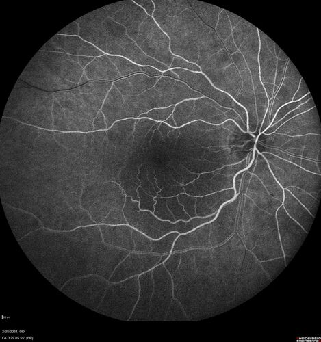 Serous Macular Detachment from Small Choroidal Melanoma
72 year old female misdiagnosed as CSR who had small choroidal melanoms.

