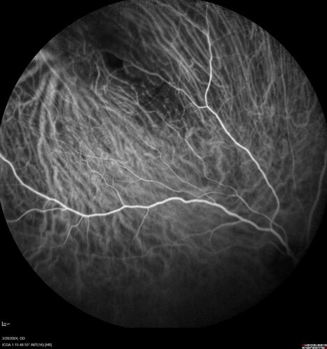 Serous Macular Detachment from Small Choroidal Melanoma
72 year old female misdiagnosed as CSR who had small choroidal melanoms.
