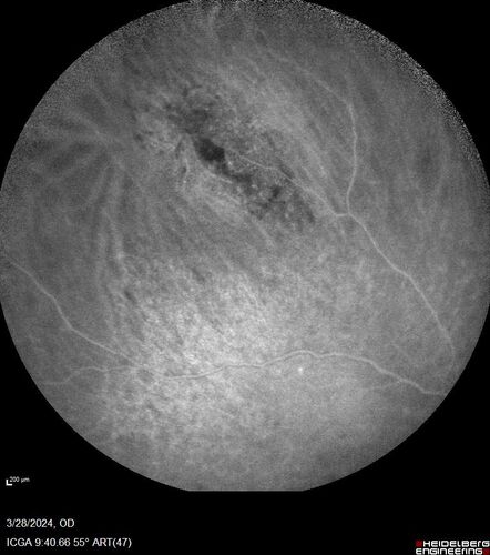 Serous Macular Detachment from Small Choroidal Melanoma
72 year old female misdiagnosed as CSR who had small choroidal melanoms.
