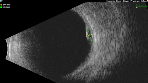 Serous Macular Detachment from Small Choroidal Melanoma
72 year old female misdiagnosed as CSR who had small choroidal melanoms.
