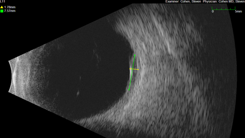 Serous Macular Detachment from Small Choroidal Melanoma
72 year old female misdiagnosed as CSR who had small choroidal melanoms.
