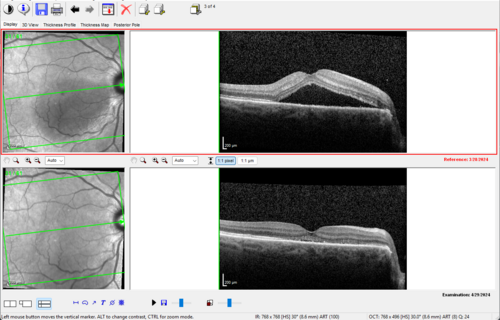 Serous Macular Detachment from Small Choroidal Melanoma
72 year old female misdiagnosed as CSR who had small choroidal melanoms.
