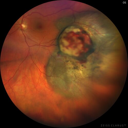 Class 2 choroidal melanoma
48 year old man with no visual complaints referred by optometrist.
Brachytherapy was done and biopsy showed a class 2 melanoma.  2 years later the patient developed liver metastases.

