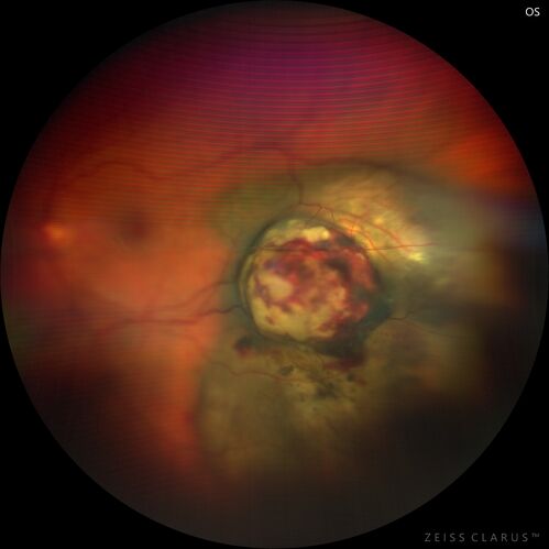 Class 2 choroidal melanoma
48 year old man with no visual complaints referred by optometrist.
Brachytherapy was done and biopsy showed a class 2 melanoma.  2 years later the patient developed liver metastases.
