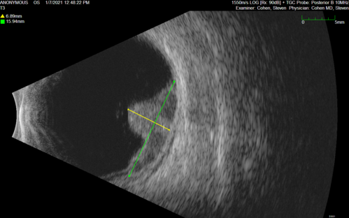 Class 2 choroidal melanoma
48 year old man with no visual complaints referred by optometrist.
Brachytherapy was done and biopsy showed a class 2 melanoma.  2 years later the patient developed liver metastases.
