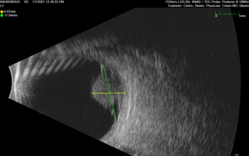 Class 2 choroidal melanoma
48 year old man with no visual complaints referred by optometrist.
Brachytherapy was done and biopsy showed a class 2 melanoma.  2 years later the patient developed liver metastases.

