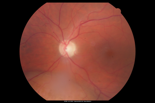 Choroidal Melanoma - Exudative Retinal Detachment 82 Year Old Man 
82-year-old man who had 3 falls 2 weeks ago. After the falls he started checking his vision and noticed there was a veil over the left eye, which he had seen for about two weeks in the superior visual field.  OD 20/25,  OS 20/40
(patient was medically never well enough for brachytherapy and died 6 months later from heart disease) 

