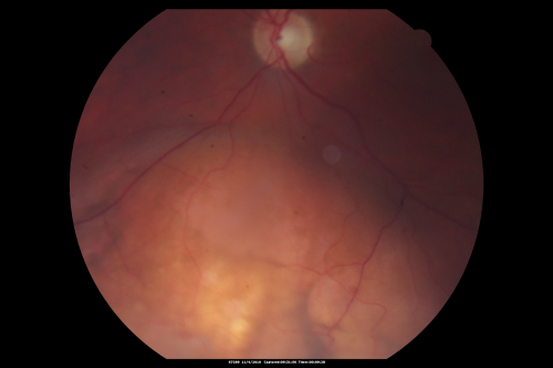 Choroidal Melanoma - Exudative Retinal Detachment 82 Year Old Man 
82-year-old man who had 3 falls 2 weeks ago. After the falls he started checking his vision and noticed there was a veil over the left eye, which he had seen for about two weeks in the superior visual field.  OD 20/25,  OS 20/40
(patient was medically never well enough for brachytherapy and died 6 months later from heart disease) 
