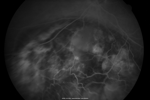 Choroidal Melanoma - Exudative Retinal Detachment 82 Year Old Man 
82-year-old man who had 3 falls 2 weeks ago. After the falls he started checking his vision and noticed there was a veil over the left eye, which he had seen for about two weeks in the superior visual field.  OD 20/25,  OS 20/40
(patient was medically never well enough for brachytherapy and died 6 months later from heart disease) 
