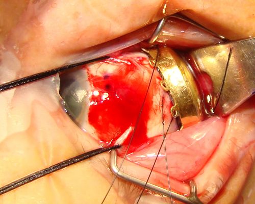 Radioactive Plaque Placement for Choroidal Melanoma Plaque Placed but not Sutured to Eye Yet
