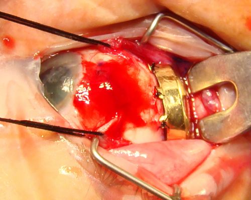 Radioactive Plaque Placement for Choroidal Melanoma Plaque Sutured to Globe
