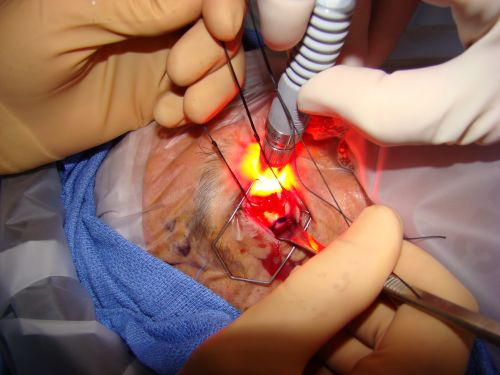 Radioactive Plaque Placement for Choroidal Melanoma  Transillumination of Globe to Localize Melanoma 
