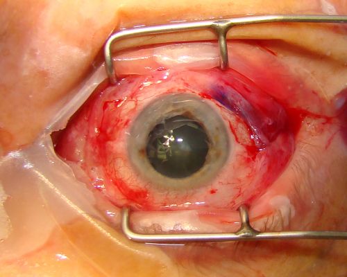 Radioactive Plaque Placement for Choroidal Melanoma Eye After Surgery with Conjunctiva Closed
