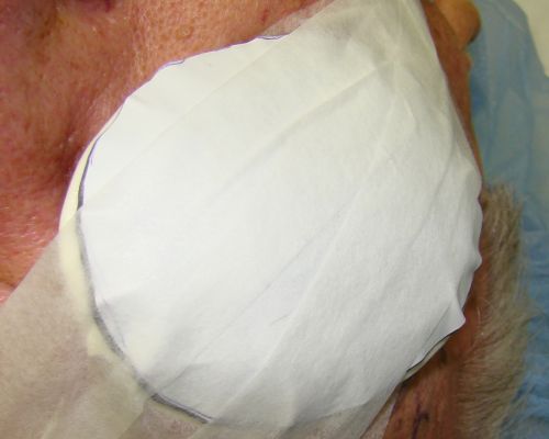 Radioactive Plaque Placement for Choroidal Melanoma  Lead Patch after Surgery
