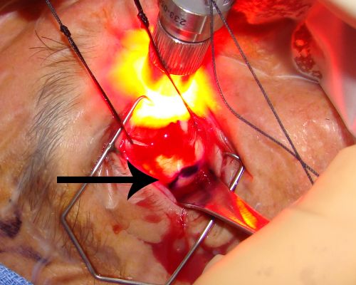 Radioactive Plaque Placement for Choroidal Melanoma  Transillumination of Globe to Localize Melanoma Arrow Points to Tumor Shadow

