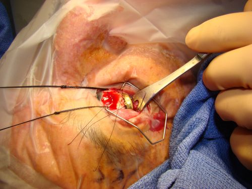 Radioactive Plaque Placement for Choroidal Melanoma  Plaque Placed but not Sutured to Eye Ye
