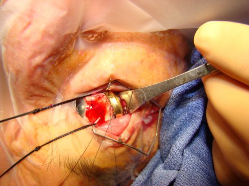 Radioactive Plaque Placement for Choroidal Melanoma  Plaque Placed but not Sutured to Eye Ye
