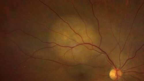 Bilateral Choroidal Tumors - Metastatic Breast Cancer
51 year old female.  First 3 sets of images show lesions growing despite systemic chemotherapy.  She eventually had external beam radiation x 15 sessions and the tumors shrunk in the last two sets of images
