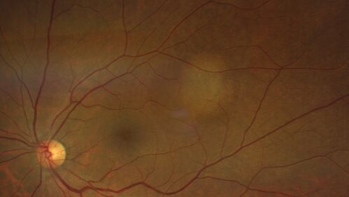 Bilateral Choroidal Tumors - Metastatic Breast Cancer
51 year old female.  First 3 sets of images show lesions growing despite systemic chemotherapy.  She eventually had external beam radiation x 15 sessions and the tumors shrunk in the last two sets of images
