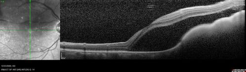 Bilateral Choroidal Tumors - Metastatic Breast Cancer
51 year old female.  First 3 sets of images show lesions growing despite systemic chemotherapy.  She eventually had external beam radiation x 15 sessions and the tumors shrunk in the last two sets of images
