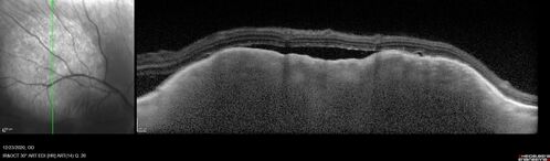 Bilateral Choroidal Tumors - Metastatic Breast Cancer
51 year old female.  First 3 sets of images show lesions growing despite systemic chemotherapy.  She eventually had external beam radiation x 15 sessions and the tumors shrunk in the last two sets of images
