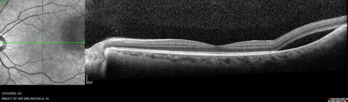 Bilateral Choroidal Tumors - Metastatic Breast Cancer
51 year old female.  First 3 sets of images show lesions growing despite systemic chemotherapy.  She eventually had external beam radiation x 15 sessions and the tumors shrunk in the last two sets of images
