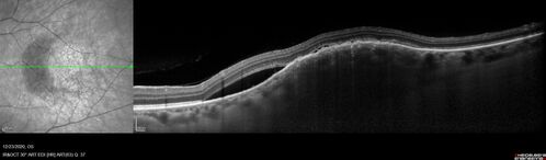 Bilateral Choroidal Tumors - Metastatic Breast Cancer
51 year old female.  First 3 sets of images show lesions growing despite systemic chemotherapy.  She eventually had external beam radiation x 15 sessions and the tumors shrunk in the last two sets of images
