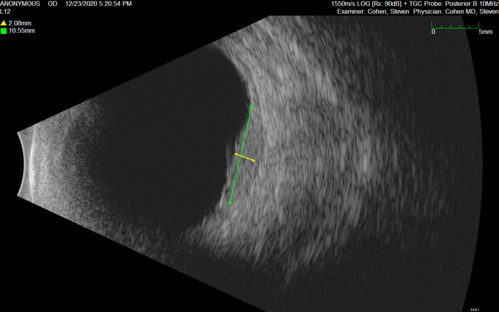 Bilateral Choroidal Tumors - Metastatic Breast Cancer
51 year old female.  First 3 sets of images show lesions growing despite systemic chemotherapy.  She eventually had external beam radiation x 15 sessions and the tumors shrunk in the last two sets of images
