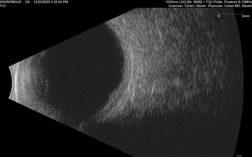 Bilateral Choroidal Tumors - Metastatic Breast Cancer
51 year old female.  First 3 sets of images show lesions growing despite systemic chemotherapy.  She eventually had external beam radiation x 15 sessions and the tumors shrunk in the last two sets of images
