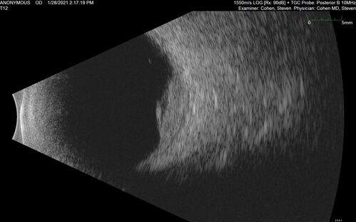 Bilateral Choroidal Tumors - Metastatic Breast Cancer
51 year old female.  First 3 sets of images show lesions growing despite systemic chemotherapy.  She eventually had external beam radiation x 15 sessions and the tumors shrunk in the last two sets of images

