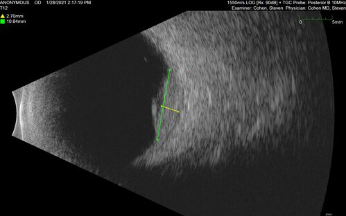 Bilateral Choroidal Tumors - Metastatic Breast Cancer
51 year old female.  First 3 sets of images show lesions growing despite systemic chemotherapy.  She eventually had external beam radiation x 15 sessions and the tumors shrunk in the last two sets of images
