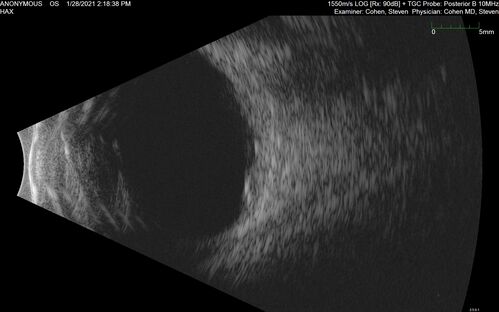 Bilateral Choroidal Tumors - Metastatic Breast Cancer
51 year old female.  First 3 sets of images show lesions growing despite systemic chemotherapy.  She eventually had external beam radiation x 15 sessions and the tumors shrunk in the last two sets of images
