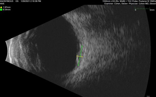 Bilateral Choroidal Tumors - Metastatic Breast Cancer
51 year old female.  First 3 sets of images show lesions growing despite systemic chemotherapy.  She eventually had external beam radiation x 15 sessions and the tumors shrunk in the last two sets of images
