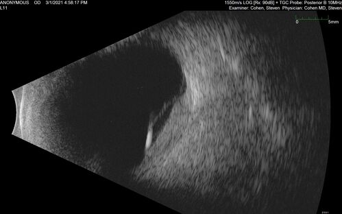 Bilateral Choroidal Tumors - Metastatic Breast Cancer
51 year old female.  First 3 sets of images show lesions growing despite systemic chemotherapy.  She eventually had external beam radiation x 15 sessions and the tumors shrunk in the last two sets of images
