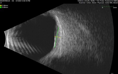 Bilateral Choroidal Tumors - Metastatic Breast Cancer
51 year old female.  First 3 sets of images show lesions growing despite systemic chemotherapy.  She eventually had external beam radiation x 15 sessions and the tumors shrunk in the last two sets of images
