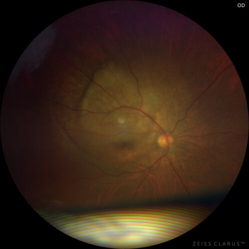 Bilateral Choroidal Tumors - Metastatic Breast Cancer
51 year old female.  First 3 sets of images show lesions growing despite systemic chemotherapy.  She eventually had external beam radiation x 15 sessions and the tumors shrunk in the last two sets of images
