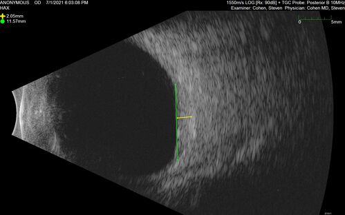 Bilateral Choroidal Tumors - Metastatic Breast Cancer
51 year old female.  First 3 sets of images show lesions growing despite systemic chemotherapy.  She eventually had external beam radiation x 15 sessions and the tumors shrunk in the last two sets of images
