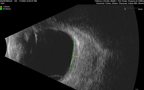 Bilateral Choroidal Tumors - Metastatic Breast Cancer
51 year old female.  First 3 sets of images show lesions growing despite systemic chemotherapy.  She eventually had external beam radiation x 15 sessions and the tumors shrunk in the last two sets of images
