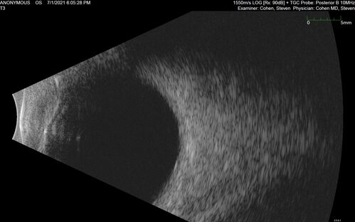 Bilateral Choroidal Tumors - Metastatic Breast Cancer
51 year old female.  First 3 sets of images show lesions growing despite systemic chemotherapy.  She eventually had external beam radiation x 15 sessions and the tumors shrunk in the last two sets of images
