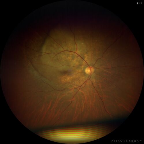 Bilateral Choroidal Tumors - Metastatic Breast Cancer
51 year old female.  First 3 sets of images show lesions growing despite systemic chemotherapy.  She eventually had external beam radiation x 15 sessions and the tumors shrunk in the last two sets of images
