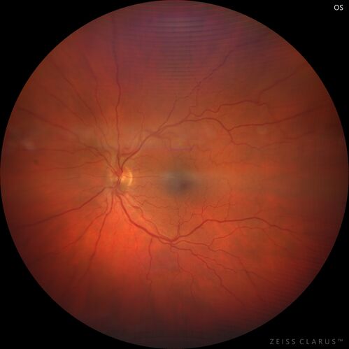 Choroidal Metastatic Breast Cancer with Exudative Detachment
58 year old female presented with 20/200 vision.  Had 10 sessions of radiation and tumor shrank.  The exudative detachment took almost a year to resolve.  The vision improved to 20/40.
