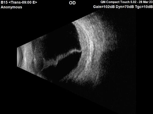 Choroidal Metastatic Breast Cancer with Exudative Detachment
58 year old female presented with 20/200 vision.  Had 10 sessions of radiation and tumor shrank.  The exudative detachment took almost a year to resolve.  The vision improved to 20/40.
