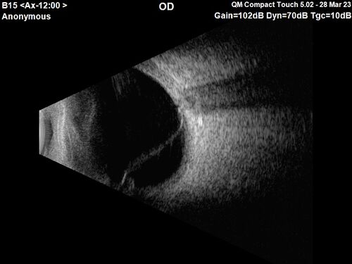 Choroidal Metastatic Breast Cancer with Exudative Detachment
58 year old female presented with 20/200 vision.  Had 10 sessions of radiation and tumor shrank.  The exudative detachment took almost a year to resolve.  The vision improved to 20/40.
