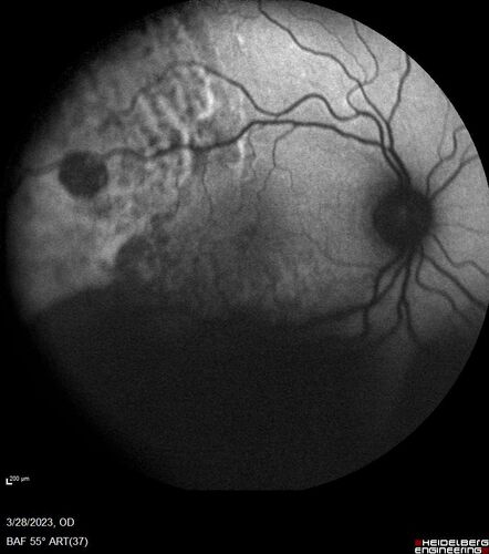 Choroidal Metastatic Breast Cancer with Exudative Detachment
58 year old female presented with 20/200 vision.  Had 10 sessions of radiation and tumor shrank.  The exudative detachment took almost a year to resolve.  The vision improved to 20/40.
